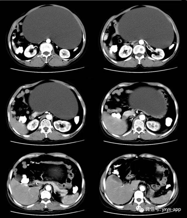 【病例】卵巢巨大单囊粘液性囊腺瘤1例CT 【病例】卵巢巨大单囊粘液性囊腺瘤1例CT