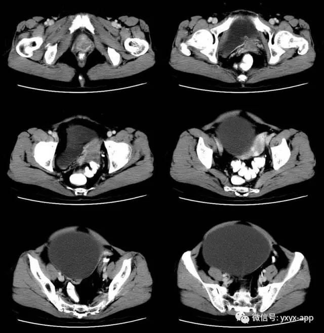 【病例】卵巢巨大单囊粘液性囊腺瘤1例CT 【病例】卵巢巨大单囊粘液性囊腺瘤1例CT