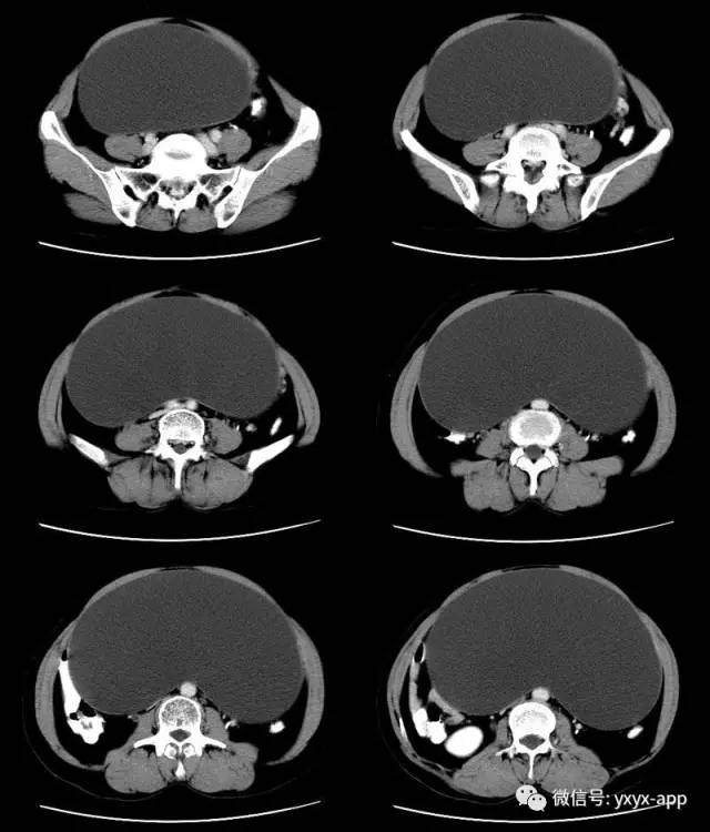 【病例】卵巢巨大单囊粘液性囊腺瘤1例CT 【病例】卵巢巨大单囊粘液性囊腺瘤1例CT