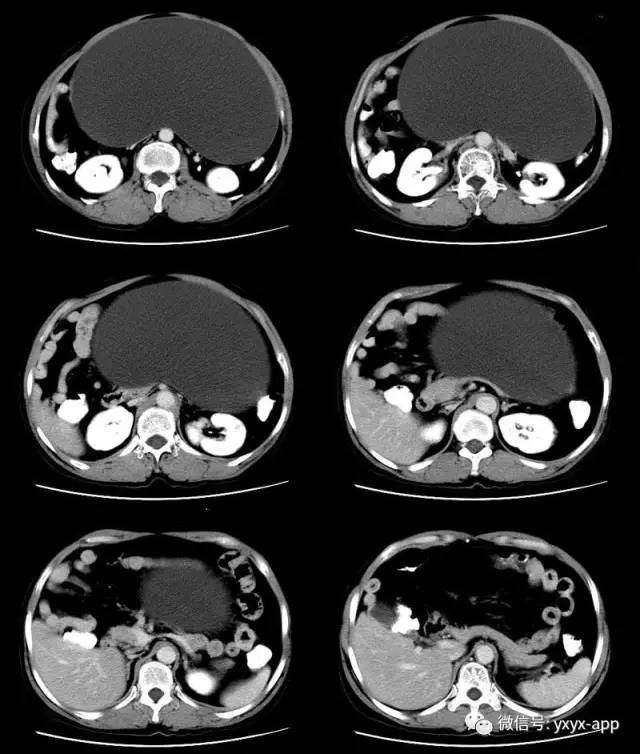 【病例】卵巢巨大单囊粘液性囊腺瘤1例CT 【病例】卵巢巨大单囊粘液性囊腺瘤1例CT