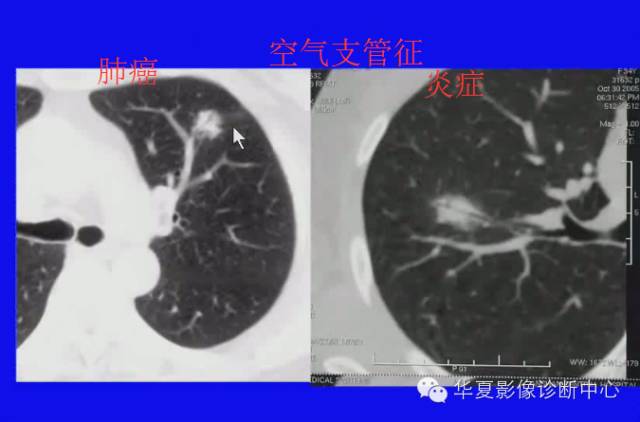 【PPT】肺癌的影像学诊断