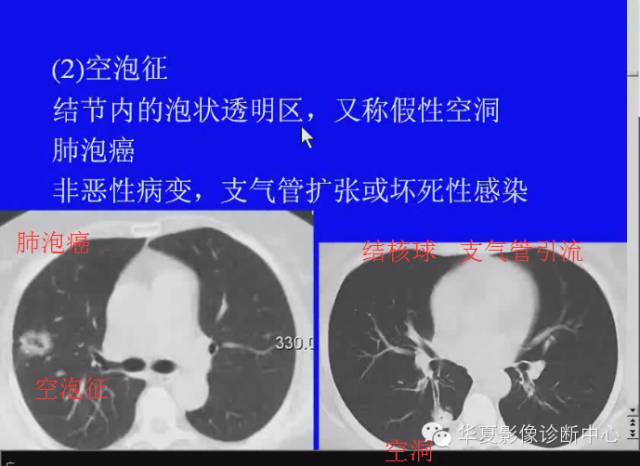 【PPT】肺癌的影像学诊断