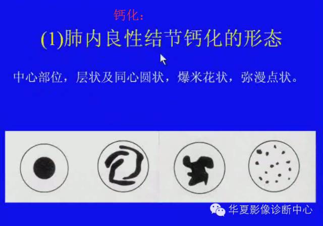 【PPT】肺癌的影像学诊断