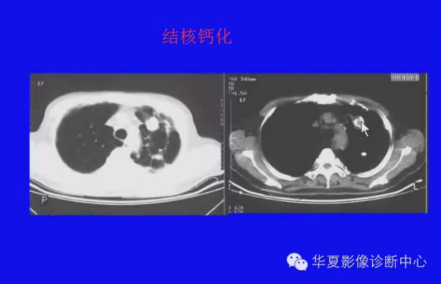 【PPT】肺癌的影像学诊断