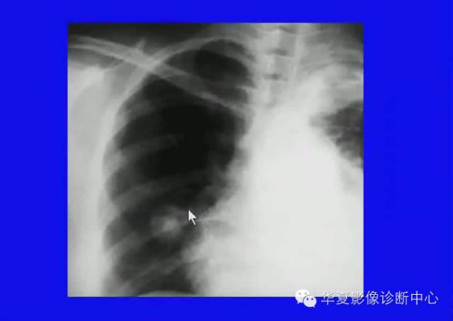 【PPT】肺癌的影像学诊断