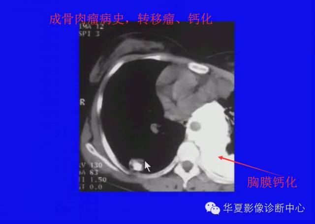 【PPT】肺癌的影像学诊断