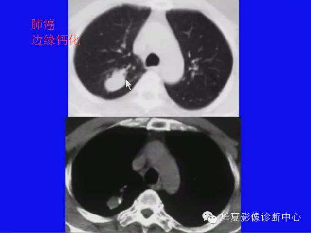 【PPT】肺癌的影像学诊断