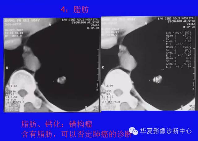 【PPT】肺癌的影像学诊断