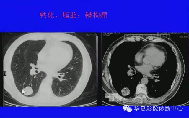 【PPT】肺癌的影像学诊断