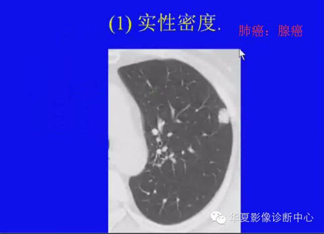 【PPT】肺癌的影像学诊断