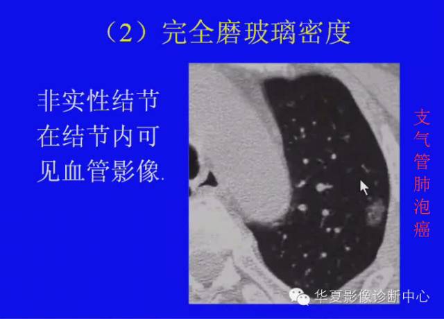 【PPT】肺癌的影像学诊断