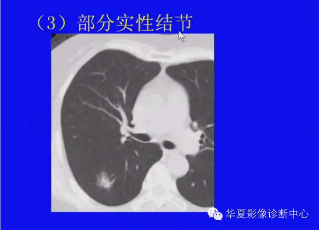 【PPT】肺癌的影像学诊断