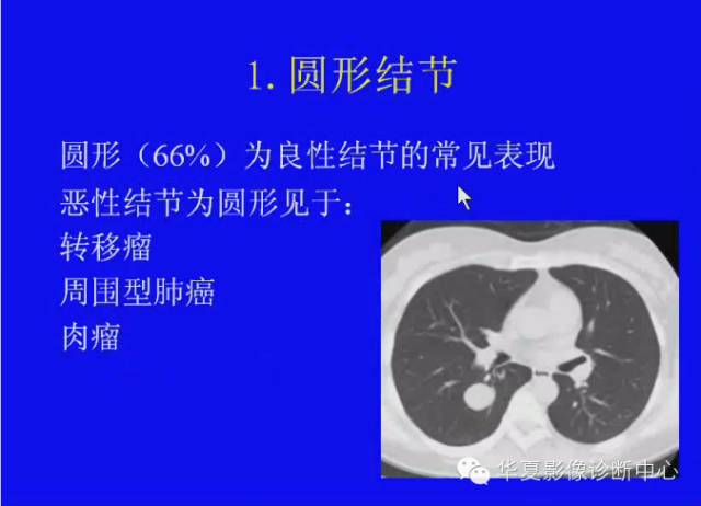 【PPT】肺癌的影像学诊断