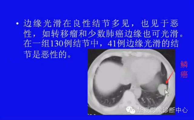【PPT】肺癌的影像学诊断