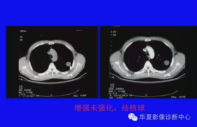 【PPT】肺癌的影像学诊断