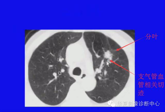 【PPT】肺癌的影像学诊断
