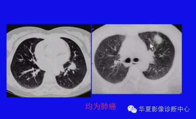 【PPT】肺癌的影像学诊断