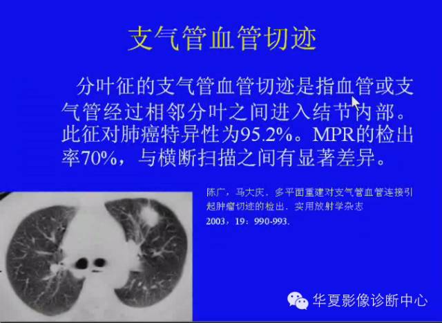 【PPT】肺癌的影像学诊断