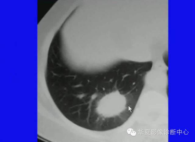 【PPT】肺癌的影像学诊断