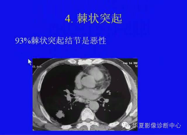 【PPT】肺癌的影像学诊断