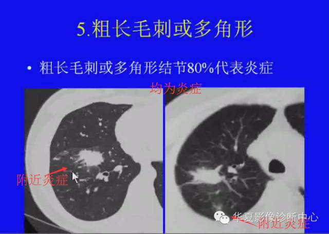 【PPT】肺癌的影像学诊断