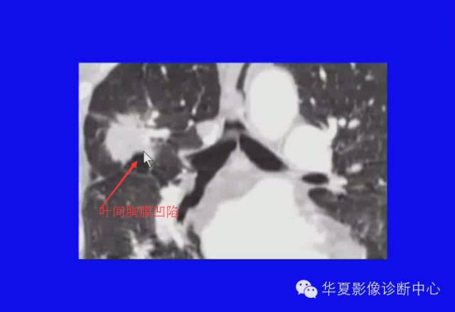 【PPT】肺癌的影像学诊断