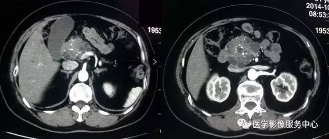 【病例】胰腺浆液性囊腺瘤1例CT影像表现