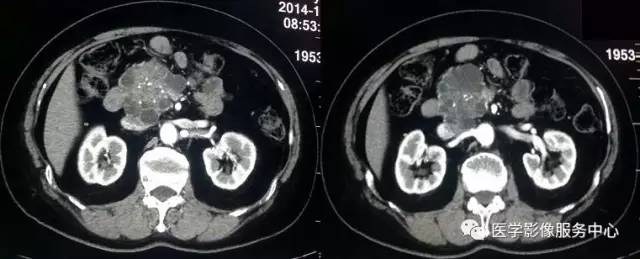 【病例】胰腺浆液性囊腺瘤1例CT影像表现 【病例】胰腺浆液性囊腺瘤1例CT影像表现