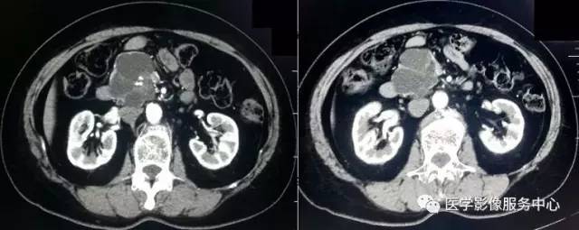 【病例】胰腺浆液性囊腺瘤1例CT影像表现 【病例】胰腺浆液性囊腺瘤1例CT影像表现