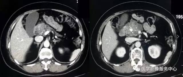 【病例】胰腺浆液性囊腺瘤1例CT影像表现 【病例】胰腺浆液性囊腺瘤1例CT影像表现