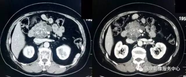 【病例】胰腺浆液性囊腺瘤1例CT影像表现 【病例】胰腺浆液性囊腺瘤1例CT影像表现