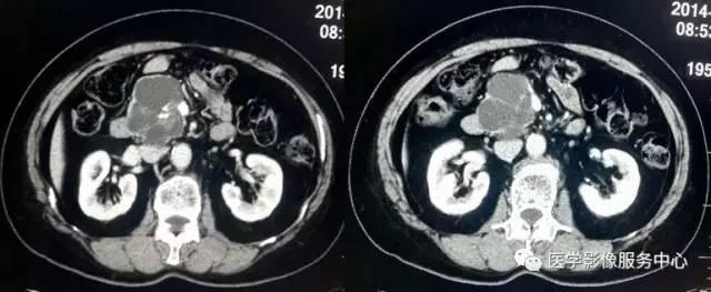 【病例】胰腺浆液性囊腺瘤1例CT影像表现 【病例】胰腺浆液性囊腺瘤1例CT影像表现