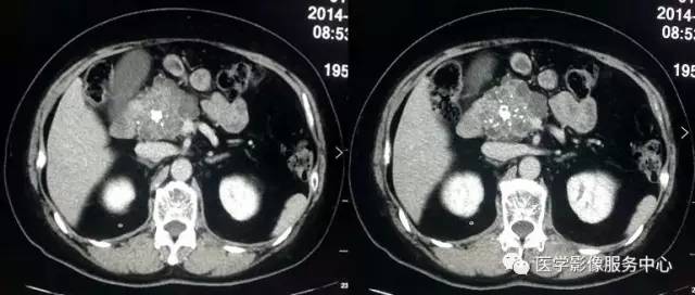 【病例】胰腺浆液性囊腺瘤1例CT影像表现 【病例】胰腺浆液性囊腺瘤1例CT影像表现