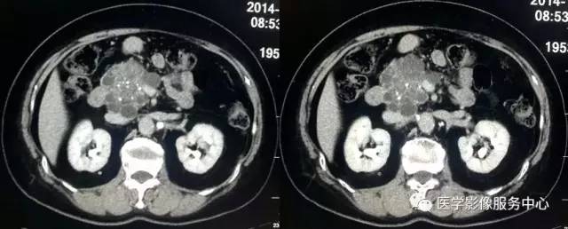 【病例】胰腺浆液性囊腺瘤1例CT影像表现 【病例】胰腺浆液性囊腺瘤1例CT影像表现
