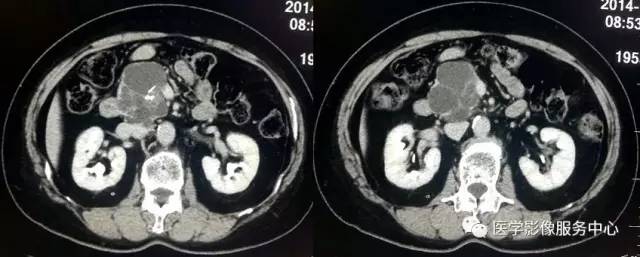 【病例】胰腺浆液性囊腺瘤1例CT影像表现 【病例】胰腺浆液性囊腺瘤1例CT影像表现