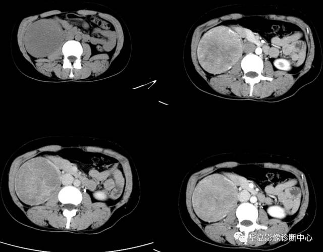 【病例】肾脏嫌色细胞癌1例CT
