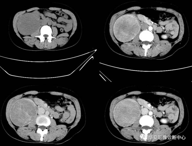 【病例】肾脏嫌色细胞癌1例CT