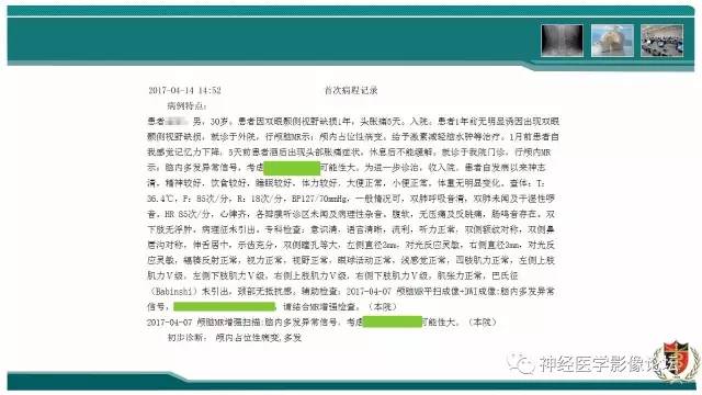 【病例】难得一见的IgG4脑炎MR