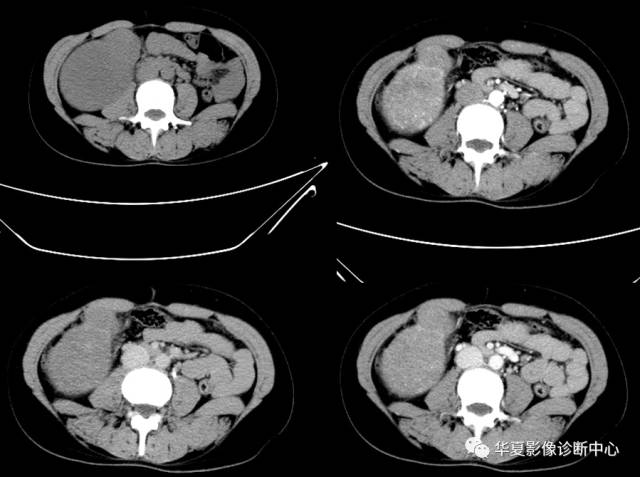 【病例】肾脏嫌色细胞癌1例CT