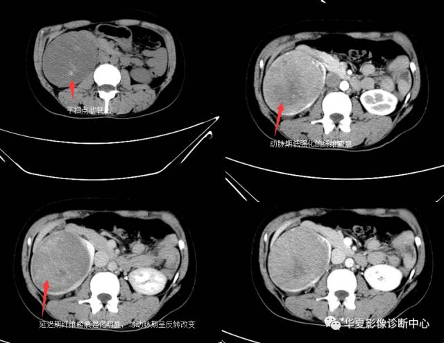 【病例】肾脏嫌色细胞癌1例CT
