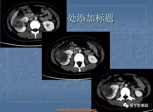 【病例】肾母细胞瘤1例CT影像表现