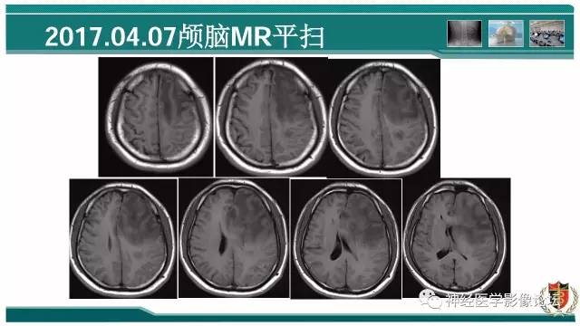 【病例】难得一见的IgG4脑炎MR