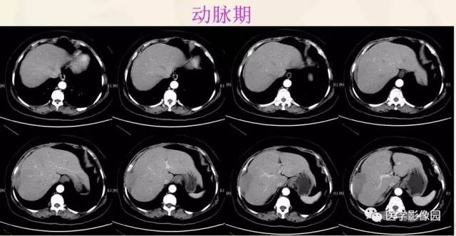 【病例】胃肠道外间质瘤1例CT