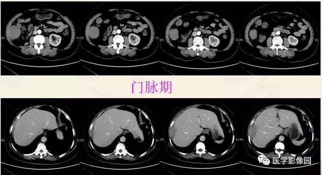 【病例】胃肠道外间质瘤1例CT
