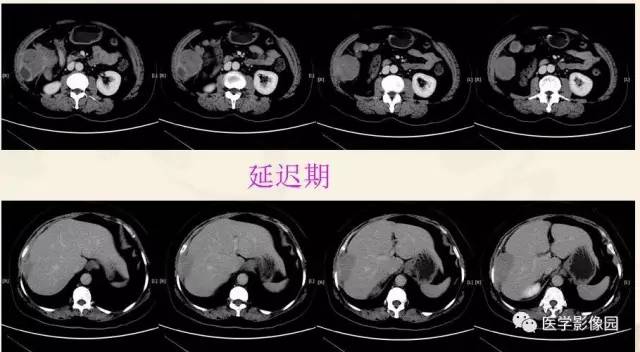 【病例】胃肠道外间质瘤1例CT