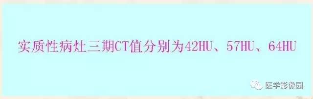 【病例】胃肠道外间质瘤1例CT