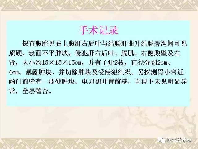 【病例】胃肠道外间质瘤1例CT