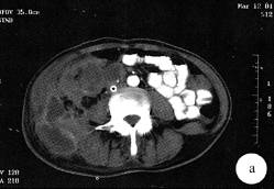【病例】盆腔结核1例CT影像表现 【病例】盆腔结核1例CT影像表现