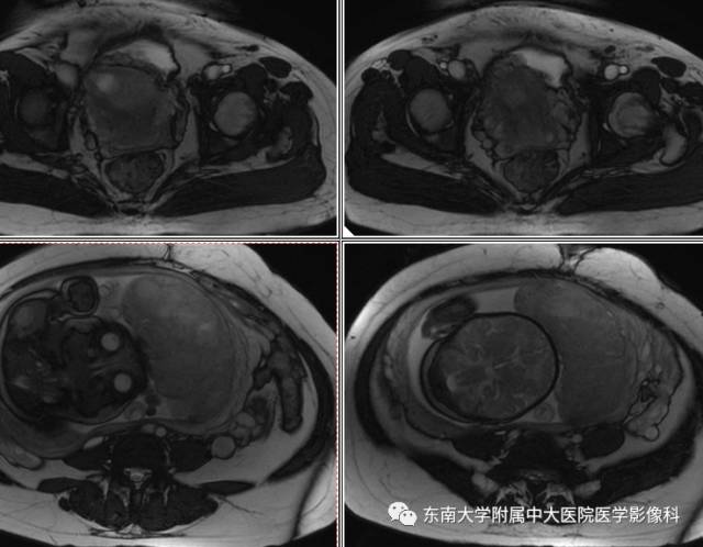 【病例】前置胎盘+胎盘植入1例MR