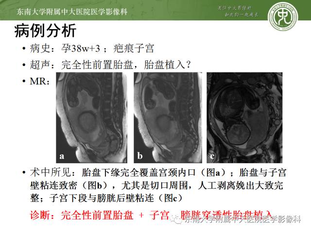 【病例】前置胎盘+胎盘植入1例MR